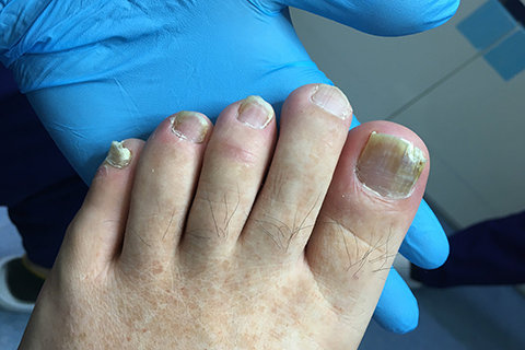 别踩这 2 个误区！很多人治不好灰指甲，问题出在这