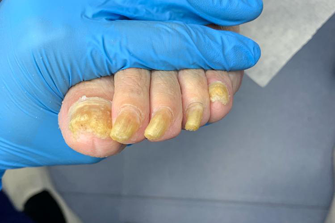 脚上的灰指甲真的很难治愈吗？